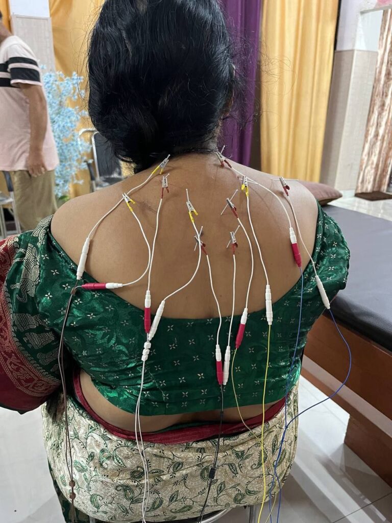 Dry Needling Technique